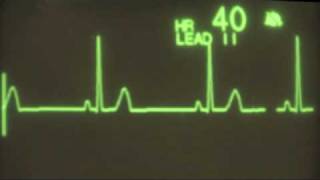 Sinus Bradycardia  ECG Training [upl. by Emogene]