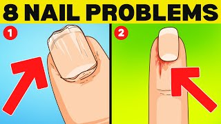 Top 8 Nail Signs of Health Problems Uncovering The Causes [upl. by Nylirehc]