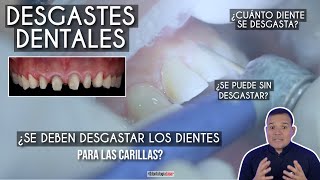 ¿Se deben desgastar los dientes para las carillas 🤔 ¿Se hace en todos los casos Odontología Láser [upl. by Aiuqram780]