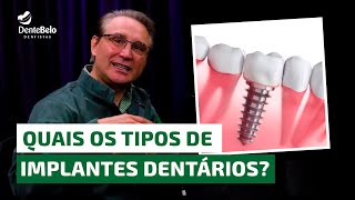 Quais os tipos de implantes dentários  DenteBelo [upl. by Andria]