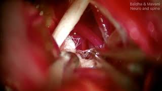 Hemifacial Spasm  Permanent Cure  MVDMicrovascular DecompressionFacial Nerve  Dr Mehul Baldha [upl. by Akimyt]