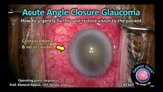 CataractCoach™ 2347 fixing acute angle closure glaucoma [upl. by Haldane]