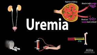 Uremia Pathophysiology Symptoms Diagnosis and Treatment Animation [upl. by Nhar]