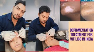 depigmentation treatment for vitiligo in india 🇮🇳 maldaभारत में विटिलिगो के लिए डीपिग्मेंटेशन उपचार [upl. by Odarbil]