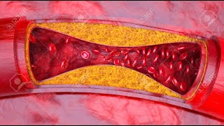 Atherosclerosis  causes symptoms diagnosis treatment pathology  Easy  Part 2 [upl. by Novj]