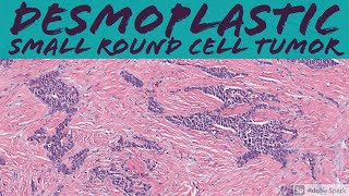 Desmoplastic Small Round Cell Tumor 5Minute Pathology Pearls [upl. by Kristopher]