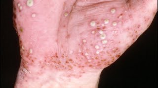 Pustular Psoriasis Diagnosing and Treating It [upl. by Aleetha]