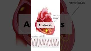 ARRITMIAS CARDÍACAS [upl. by Llertnad]