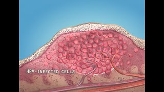 What are warts HPV  3D animation [upl. by Iggie]