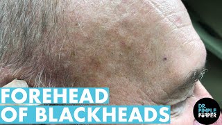 A Forehead of Blackhead Extractions Dr Pimple Popper Mines a Patients Head [upl. by Schnur]