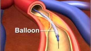 Percutaneous coronary Intervention stenting [upl. by Emelyne]