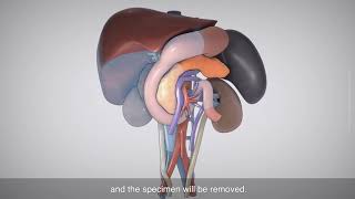 Whipple procedure with extended right hepatectomy right nephrectomy and reconstruction of PVIVC [upl. by Froh]