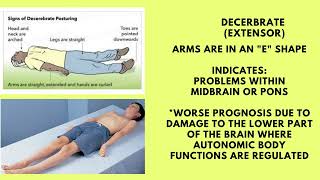 TBI Posturing Decerebrate vs Decorticate [upl. by Kery]