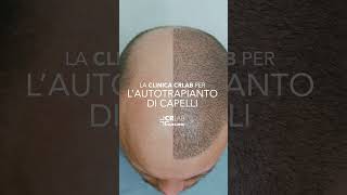 CRLAB Hair Clinic lAutotrapianto firmato CRLAB [upl. by Amye]