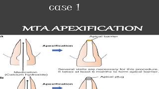 MTA APEXIFICATION case 1 apexification steps [upl. by Sherwin]