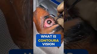 What Is Contoura Vision Surgery [upl. by Klarika893]