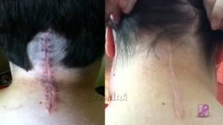 Chiari Malformation 1 Year PostOp [upl. by Creamer]