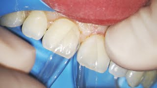 Tooth Bonding to Close Spaces [upl. by Leuas]