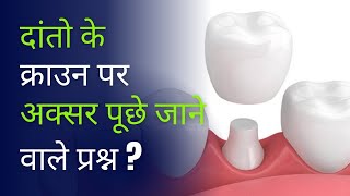 दांतो के क्राउन पर अक्सर पूछे जाने वाले प्रश्न   Faqs on Crowns [upl. by Pacificia587]