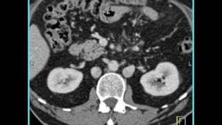 Duplication of IVC [upl. by Eelyam989]