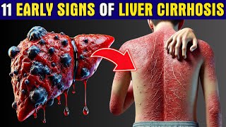 LIVER is DYING 11 Early Warning Signs of Liver Cirrhosis You Cant Ignore  Healthy Care [upl. by Culliton]