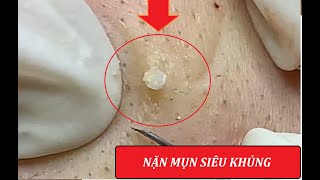 Giant blackheads amp Severe cystic acne squeezed 4  Loan Nguyen [upl. by Eivi66]