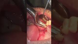 Extraction of upper right second molar roots [upl. by Haem141]