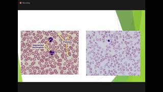 Hematology PEDIATRICS Cong hemolytic anemia amp IMNCI [upl. by Leicester]