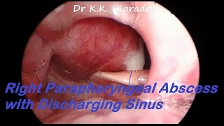 Right Parapharyngeal Abscess with Discharging Sinus  Endoscopic View [upl. by Llertniuq]