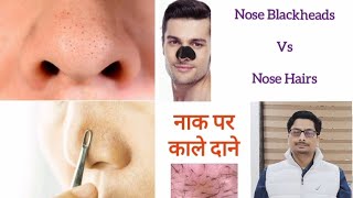 Trichostasis Spinulosa  Nose Blackheads  Nose Hairs  Nose Acne नाक पर काले दाने और बाल nosehair [upl. by Astera]