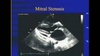 Mitral stenosis Dr S K Parashar [upl. by Crudden]