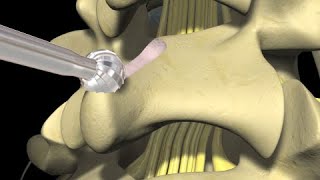 Low Back Pain Lumbar Laminectomy Surgery [upl. by Ajssatan]