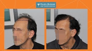 5200 Graft Hair Transplant Results  Feller amp Bloxham  NY NYC Long Island PA NJ [upl. by Xonk]