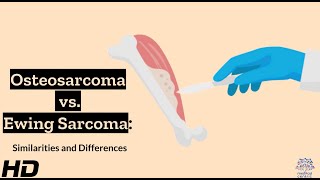 Osteosarcoma vs Ewing Sarcoma A Comparative Analysis [upl. by Collum60]