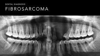 Fibrosarcoma [upl. by Mullane]