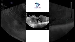 Unruptured right ectopic tubal gestationdamayanthichandana [upl. by Kerwin757]