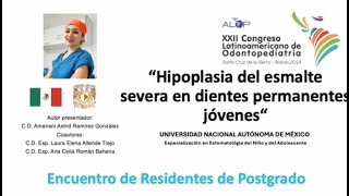 ER32 386 Hipoplasia del esmalte severa en dientes permanentes jóvenes [upl. by Nothgiel92]