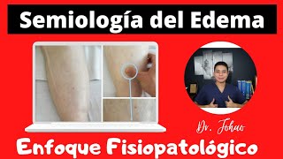 Semiología del EDEMA  Enfoque Fisiopatológico [upl. by Sharlene]