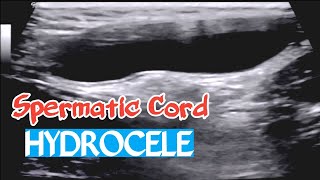 Ultrasound  Spermatic cord Hydrocele [upl. by Reiners]