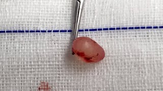 Epididymal Cyst [upl. by Tnarb749]