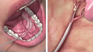 Sialendoscopy  Salivary Gland Stone Extraction [upl. by Inama]