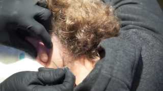 Popping large cyst behind ear [upl. by Boote]