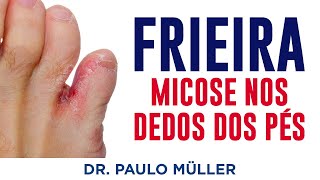 Frieira Micose Entre os Dedos do Pé – Dr Paulo Müller Dermatologista [upl. by Lissner92]