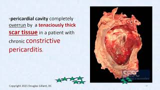 CVPP WK7 Thursday SPR 21Cardiac tamponade Kussmauls sign pulsus paradoxus and EKG PT 1 [upl. by Yellas318]