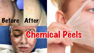 CHEMICAL PEEL TREATMENT  Glycolic Peel Salicylic Peel amp Lactic Peel  Chemical Peels In India [upl. by Youngman]