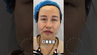 筋膜提升 beauty 面膜 醫美推薦 makeupartist 推薦 [upl. by Bonnes724]