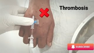 IV Cannula practiceCannula success but thrombosis [upl. by Enidanreb871]