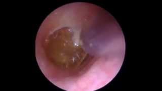 Endoscopic Suction Ear Wax Removal in Leicester  The Hear Clinic [upl. by Auehsoj666]