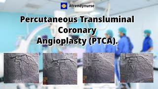 cathlab angiogram coronary angioplasty Percutaneous Transluminal Coronary Angioplasty PTCA [upl. by Ariek858]