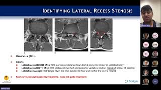 Neurogenic Claudication  Lateral Recess Stenosis  Ryan Khanna MD [upl. by Seuguh202]